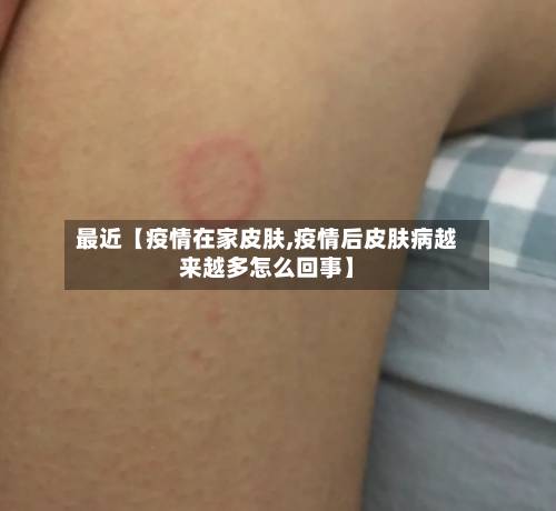 最近【疫情在家皮肤,疫情后皮肤病越来越多怎么回事】