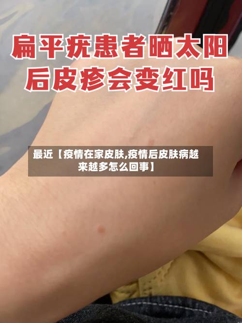 最近【疫情在家皮肤,疫情后皮肤病越来越多怎么回事】-第2张图片